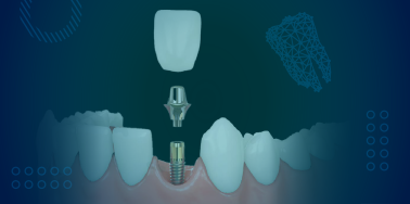 Standard Implant Crown (including abutment)
